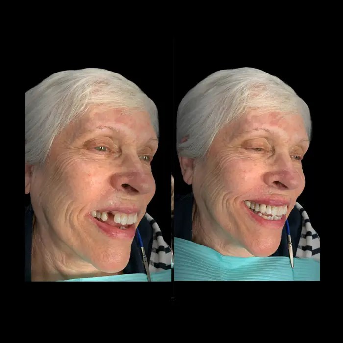 Single Tooth implant & bridges — NASHVILLE DENTURES AND IMPLANTS