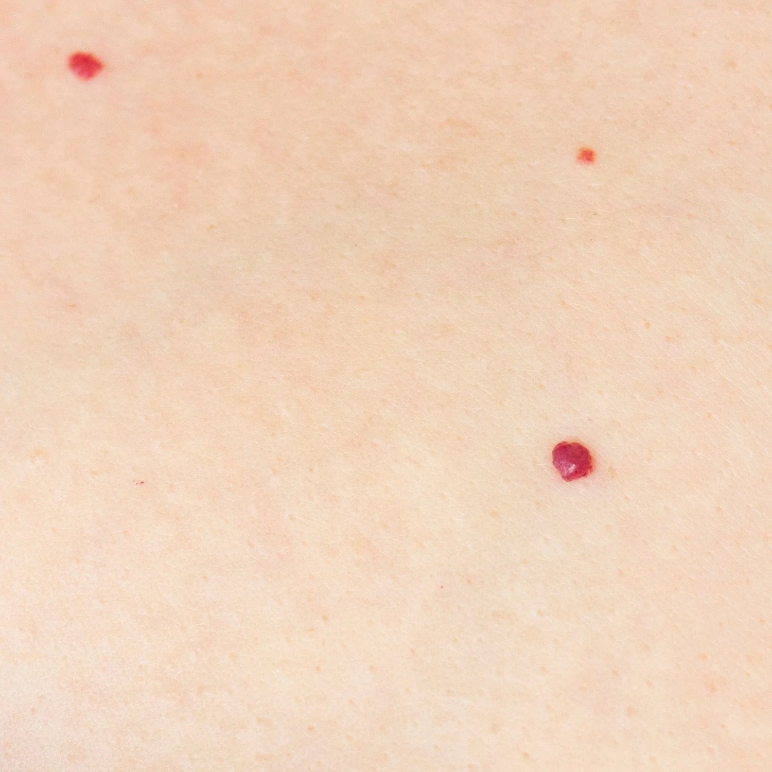 Cherry Angiomas Treatment by Naturasil