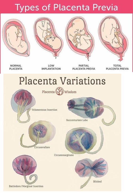 Placenta variations and what they look like NCLEX Quiz