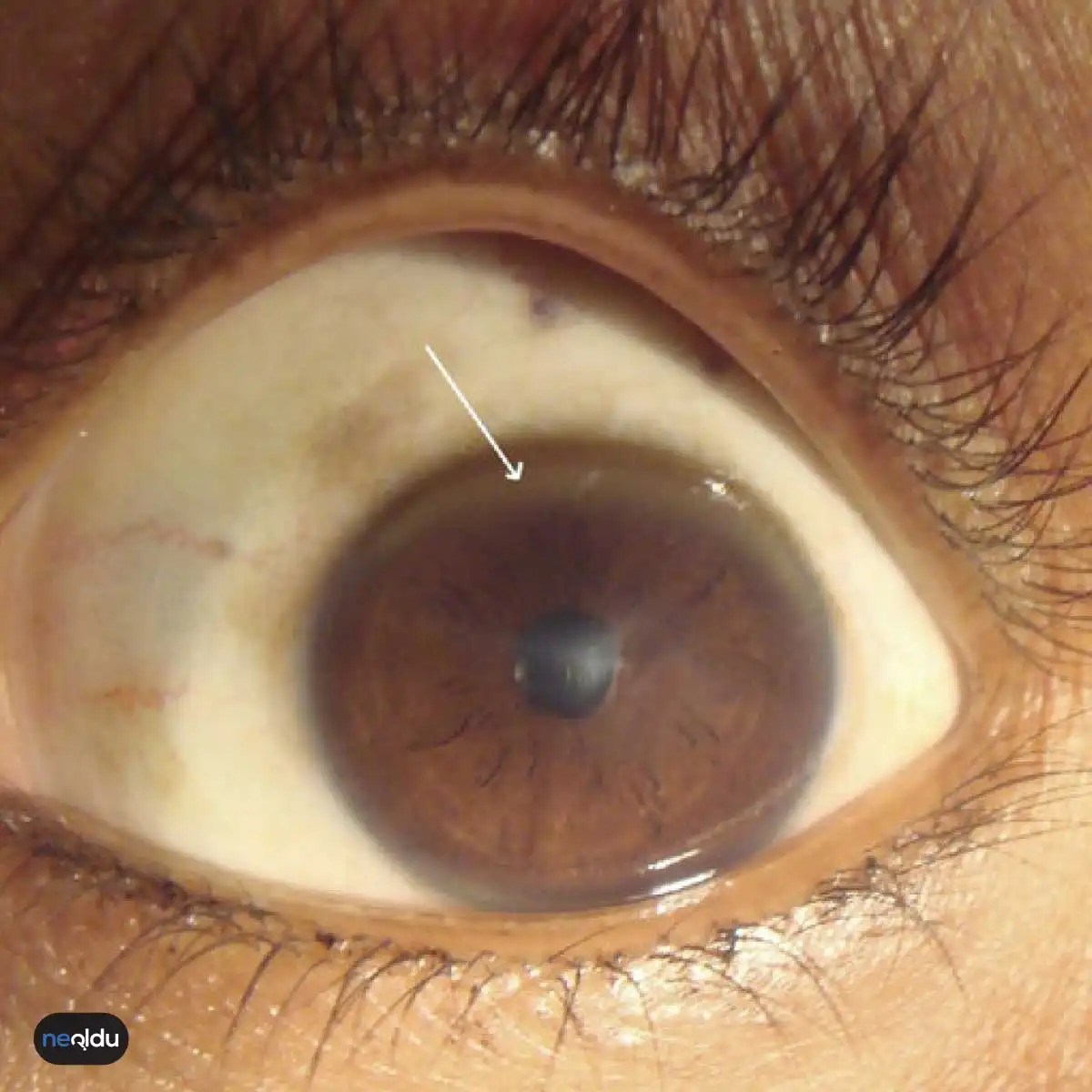 Wilson Hastalığı Nedir, Belirtileri ve Tedavisi Nelerdir?