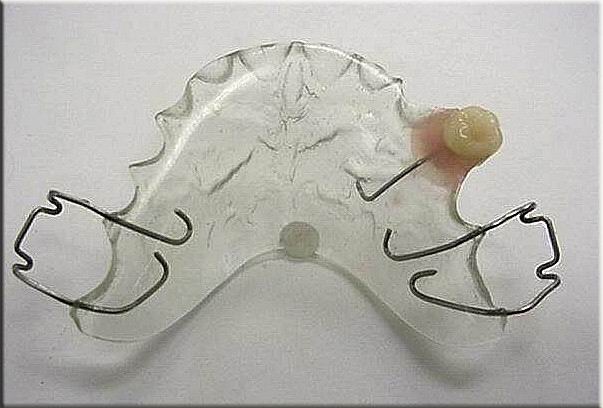 Flipper Temporary Bridge, Fake Tooth or Flipper