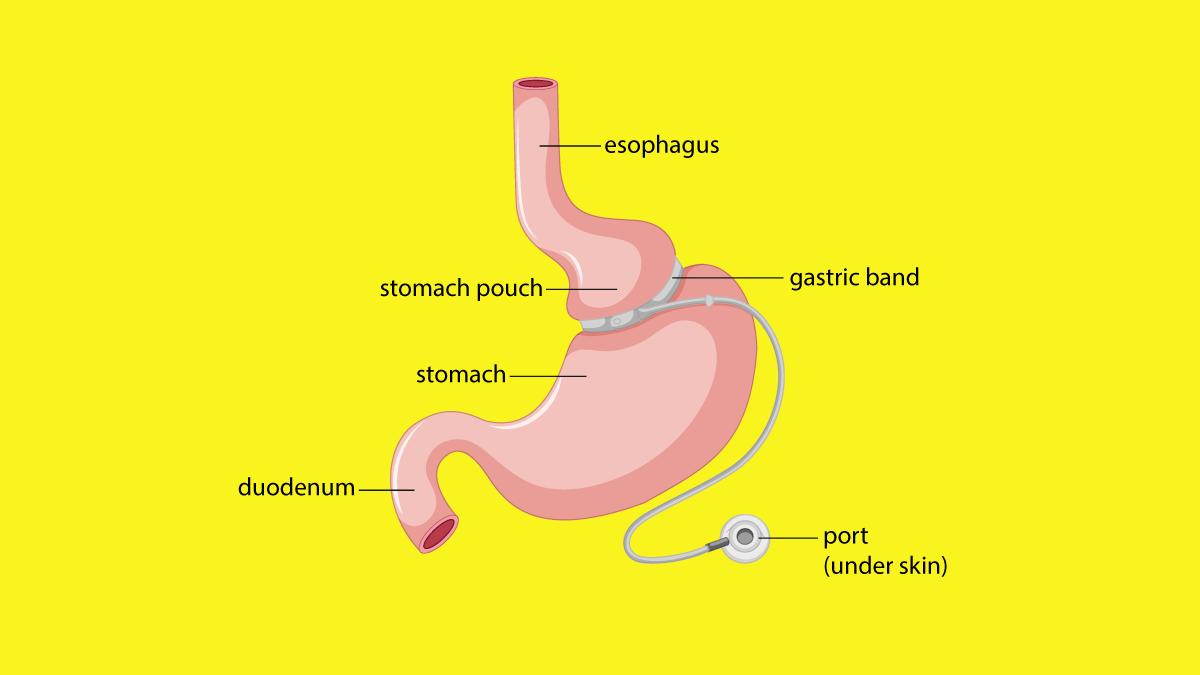 What is Gastric Banding and How it Works Nerdynaut