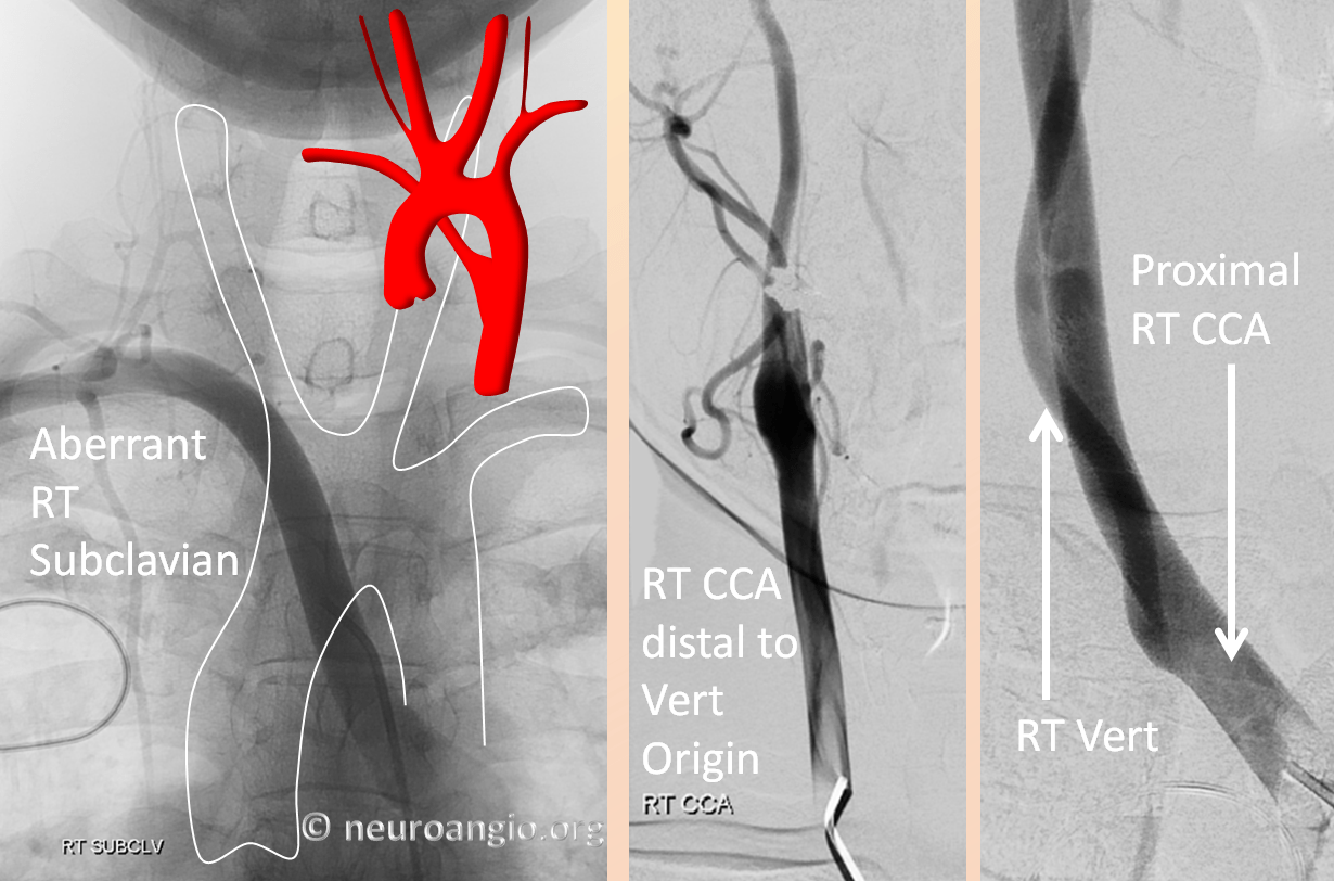 Aortic Arch | Neuroangio.org