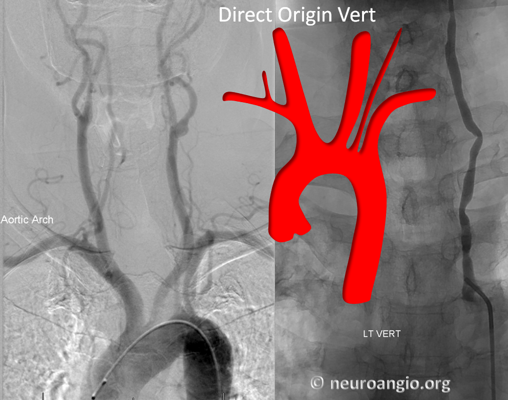 Aortic Arch | Neuroangio.org