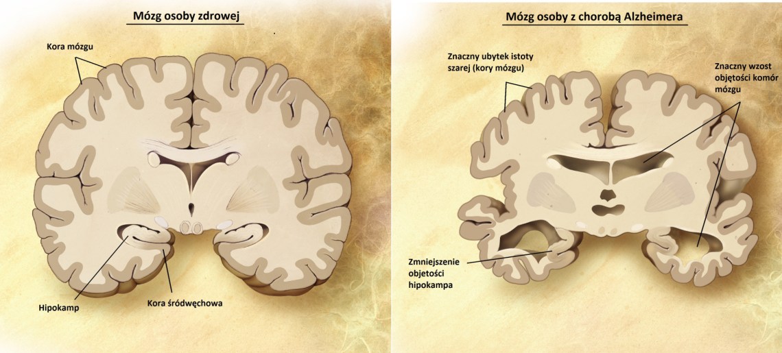 Mój osoby z chorobą Alzheimera
