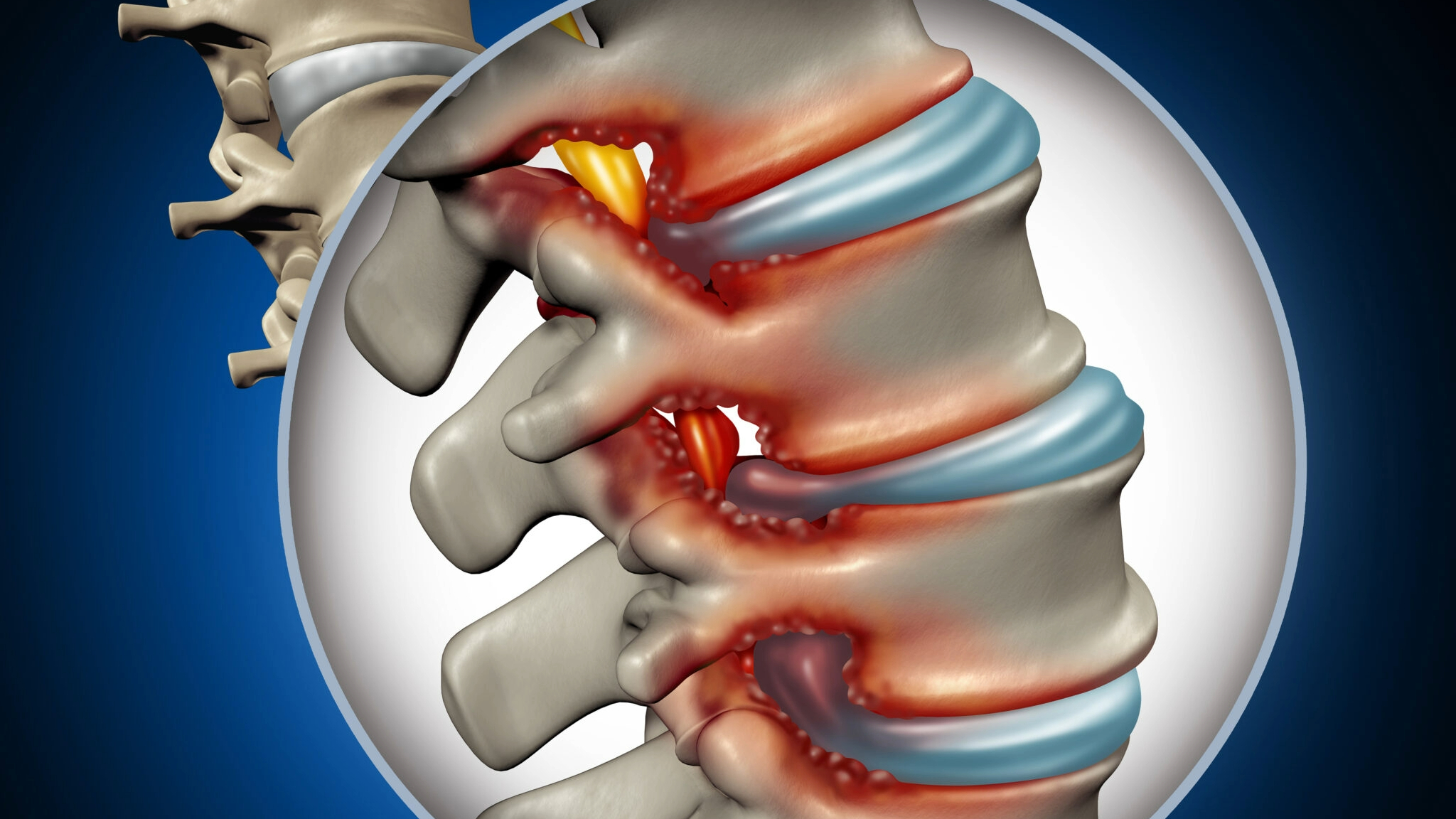 Spinal Stenosis Causes, Symptoms and Treatment