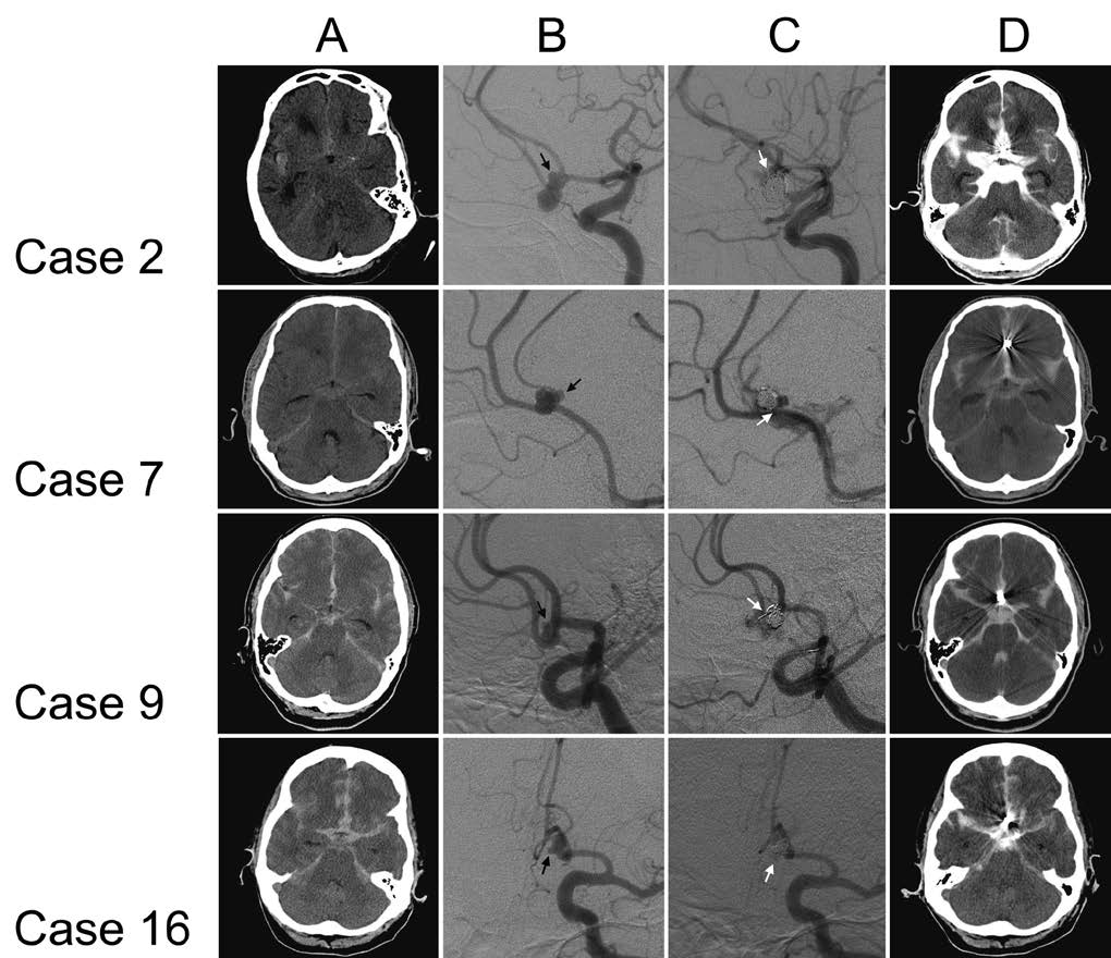 Morphological predictors of intraprocedural rupture during coil