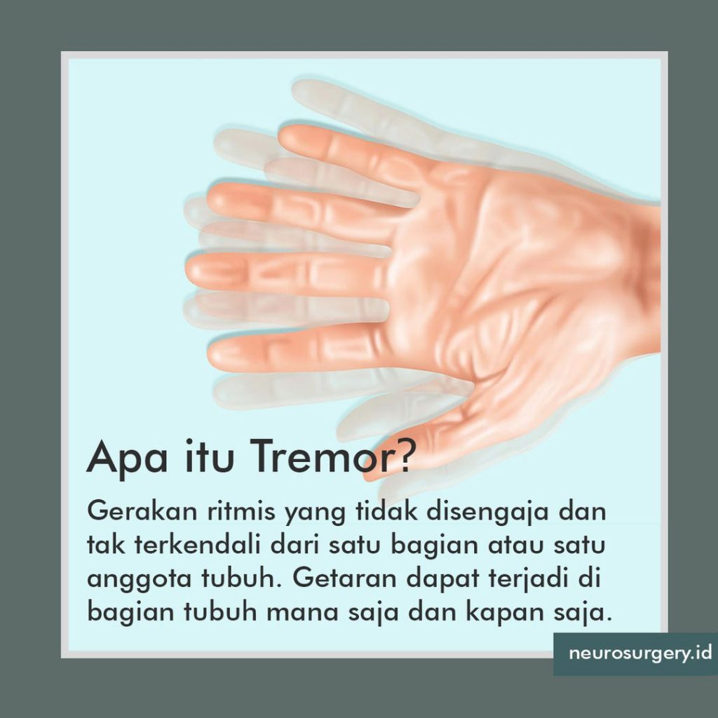 Apa Itu Tremor ? Neurosurgery