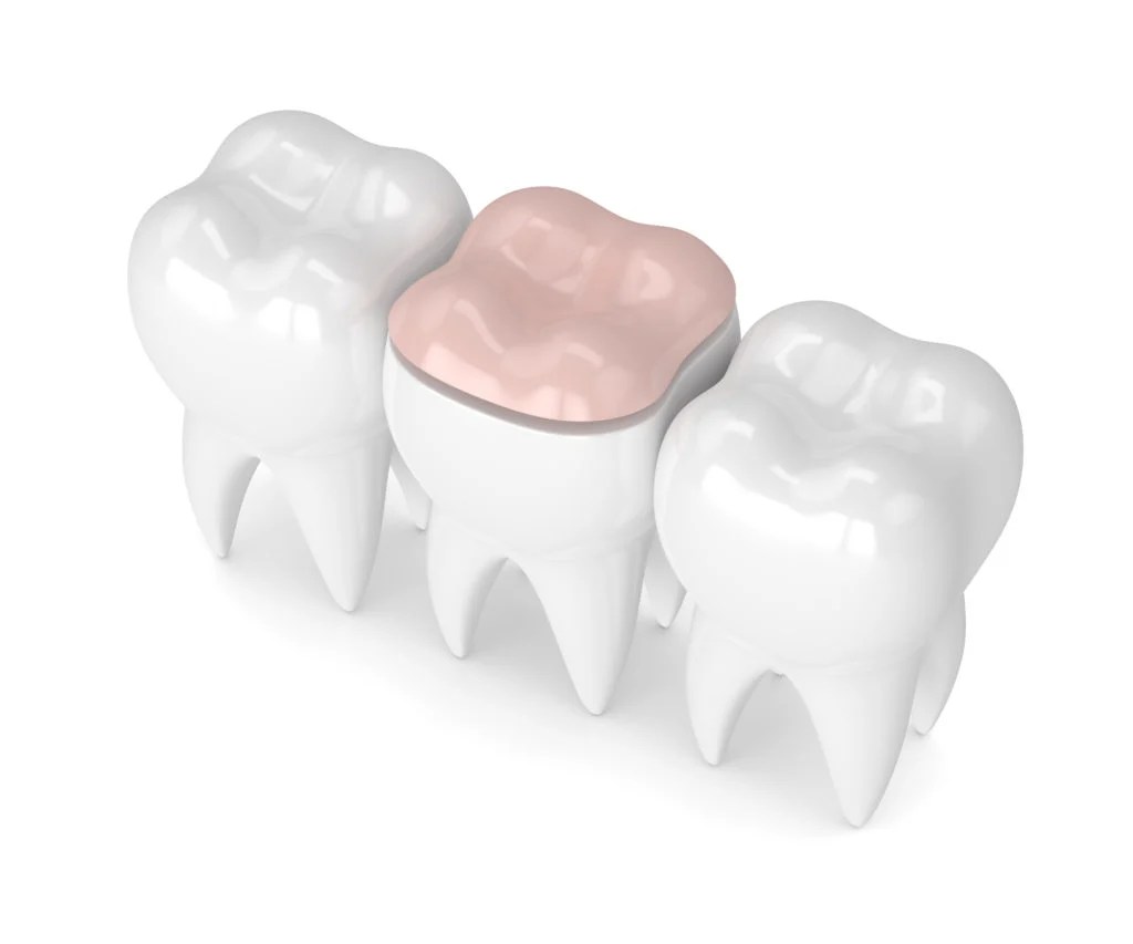 Composite Fillings Pros, Cons, Costs & Pictures