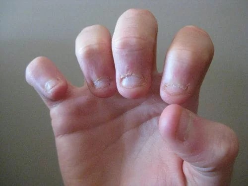 Voor Eens En Voor Altijd Stoppen Met Nagelbijten Door Stress - Newstart.nl