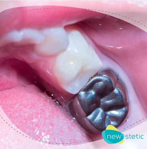 Ventajas Y Desventajas De Amalgamas