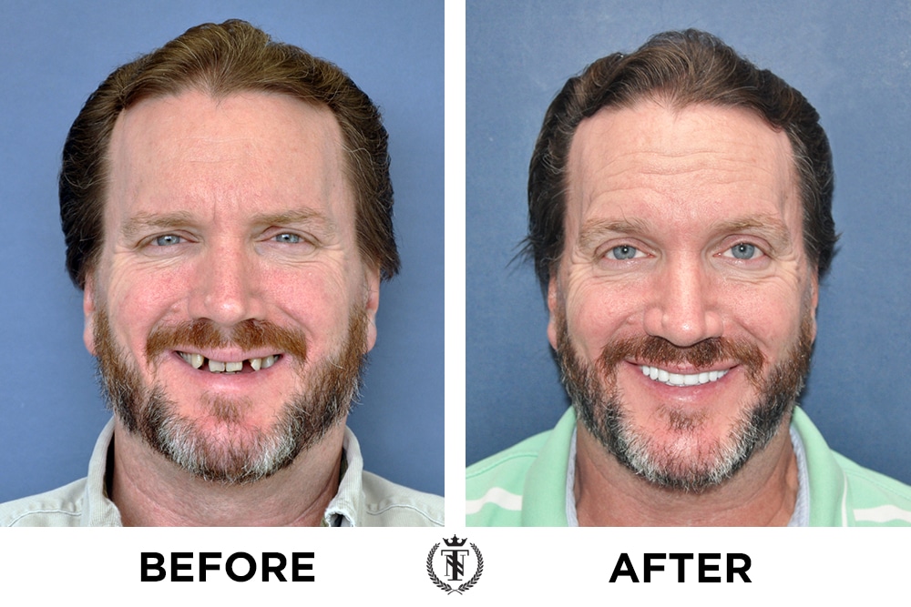 New Teeth Now Smiles Our Dental Implants Patients