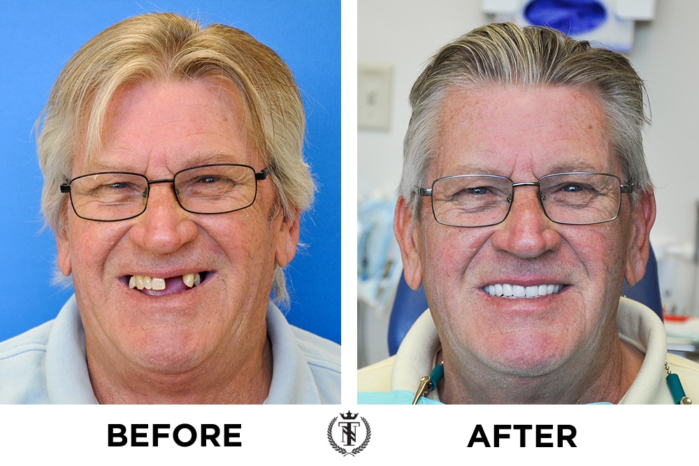 New Teeth Now Smiles Our Dental Implants Patients
