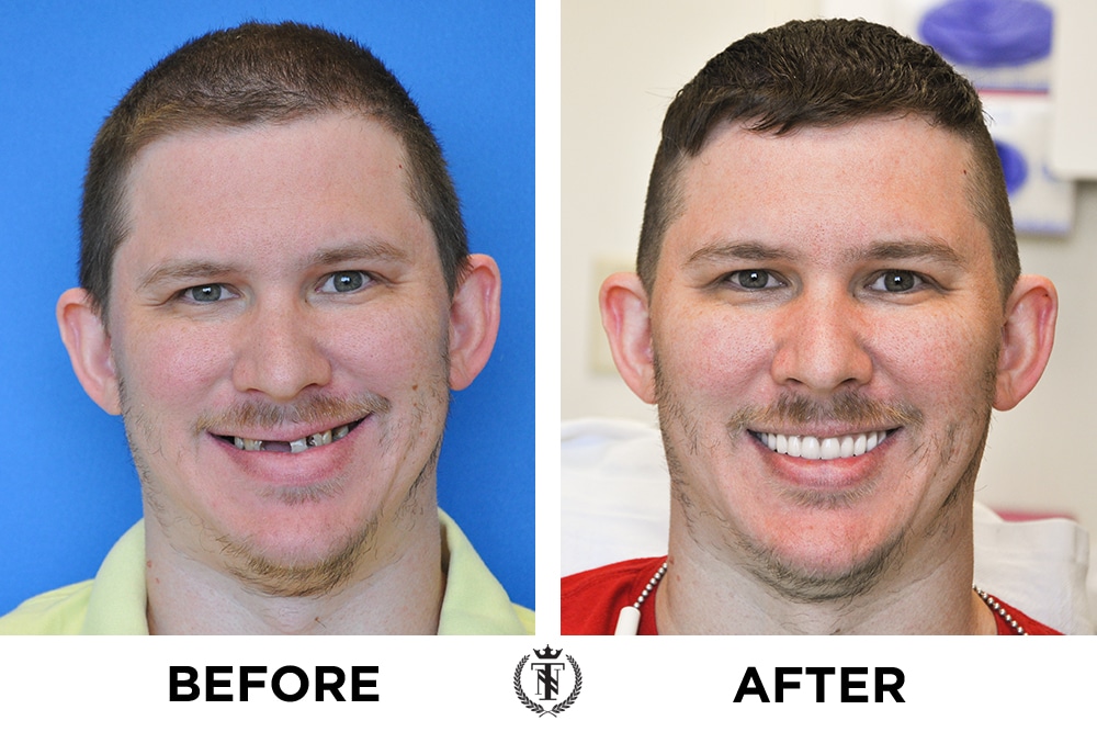 New Teeth Now Smiles Our Dental Implants Patients