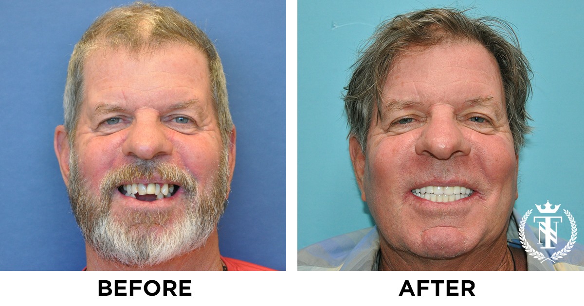 Dental Implants Melbourne Tampa Orlando Florida