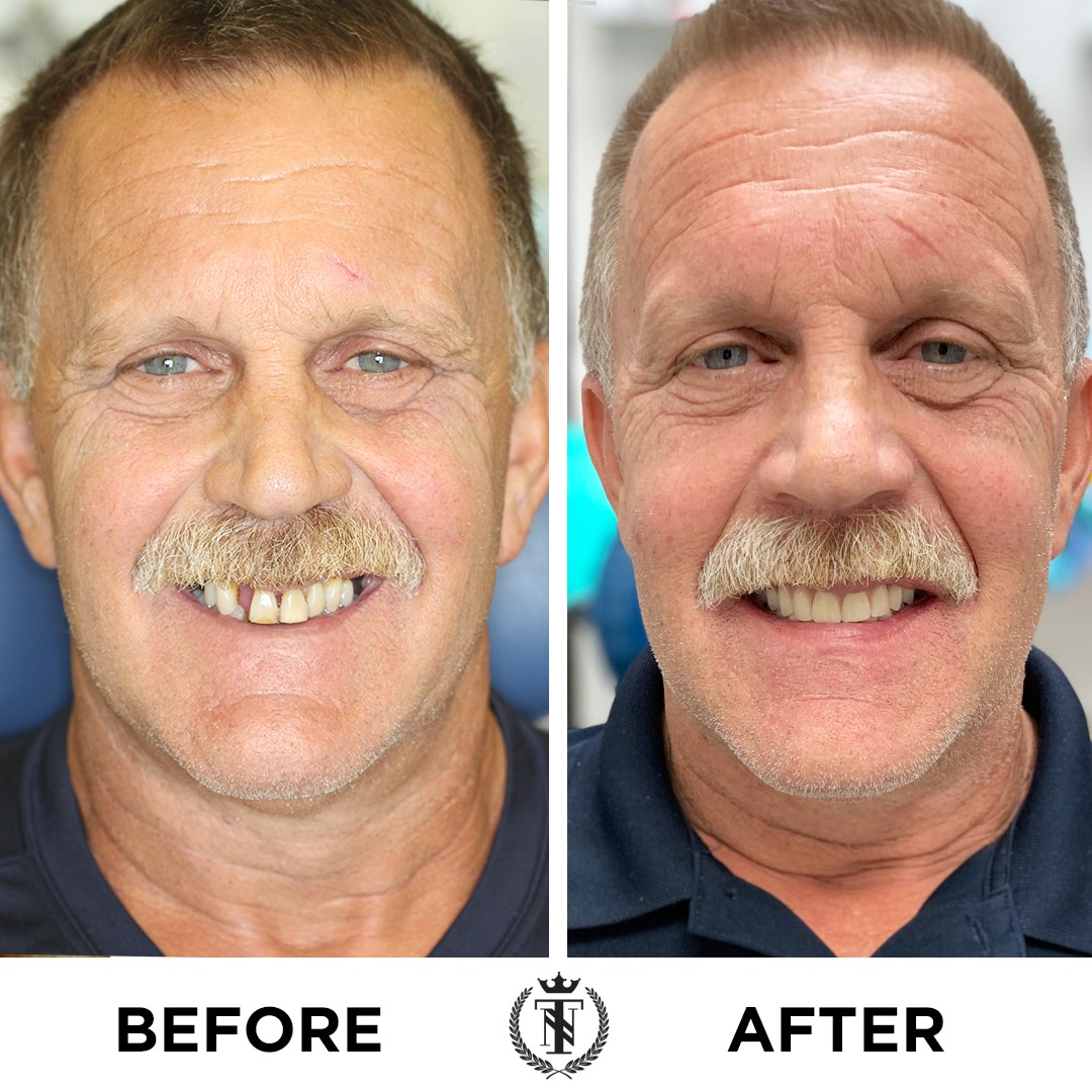 Dental Implants Melbourne Tampa Orlando Florida