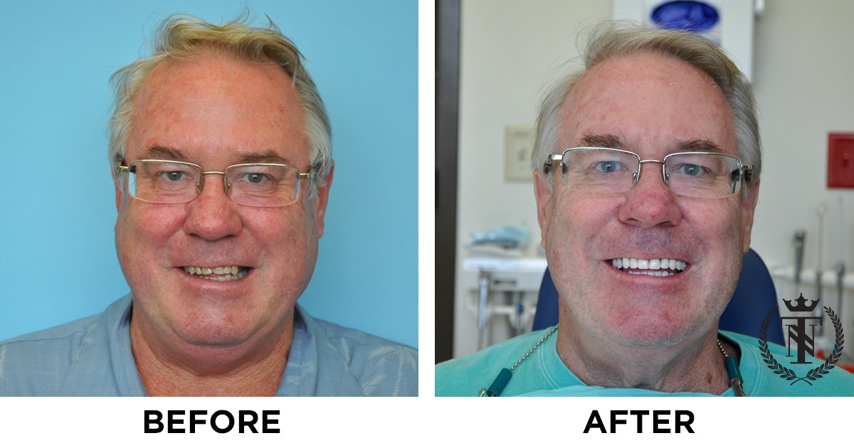 Dental Implants Melbourne Tampa Orlando Florida