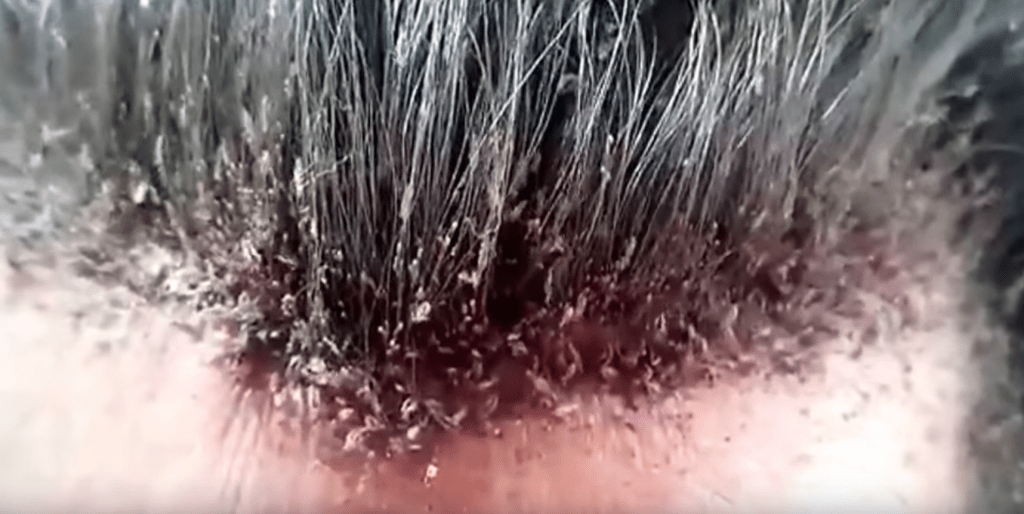 How to get rid of Head Lice, control Pediculus Humanus problems Nexles