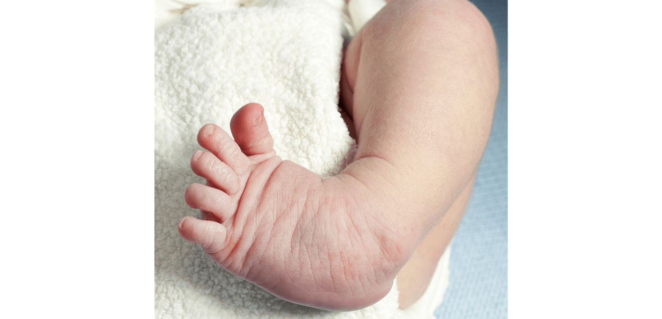 Clubfoot Curved Baby Feet Next Step Foot & Ankle Clinic