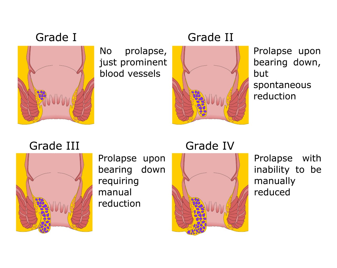 Piles Treatment Haemorrhoid Surgery Singapore Nexus Surgical