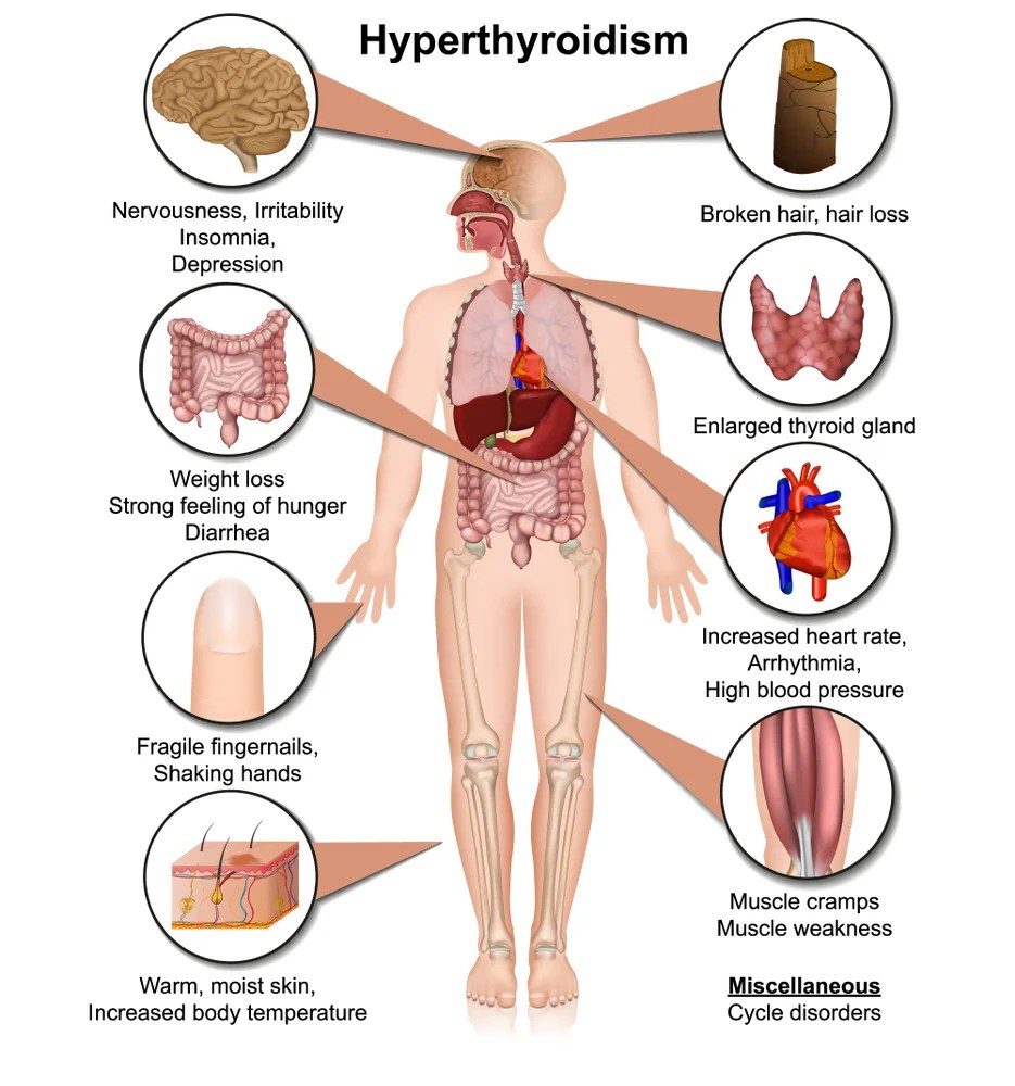 Thyroid Disorders Hyperthyroidism • Waterdown • Naturopath • Natural Health Clinic of Halton