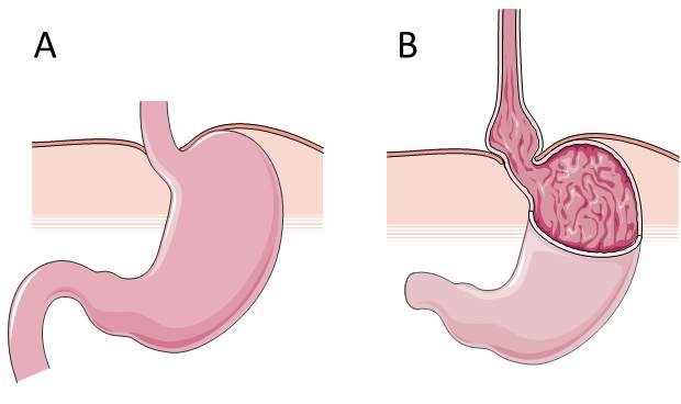 Gastro-Oesofageale Reflux | Voedingsinfo Nice