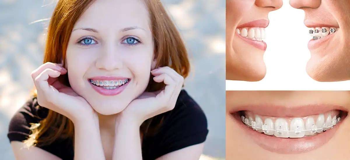 Types of Appliances/Braces Pacific Orthodontics