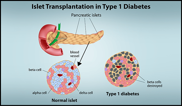 Islet Transplantation Improves Quality of Life for People with Hardto