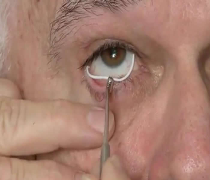 Causes, Symptoms, Treatment, Diagnosis and Prevention