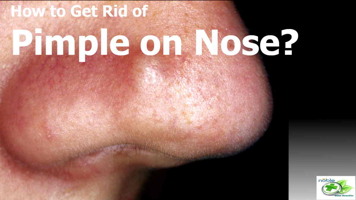 How to Get Rid of Pimples on Nose 6 Best Home Remedies