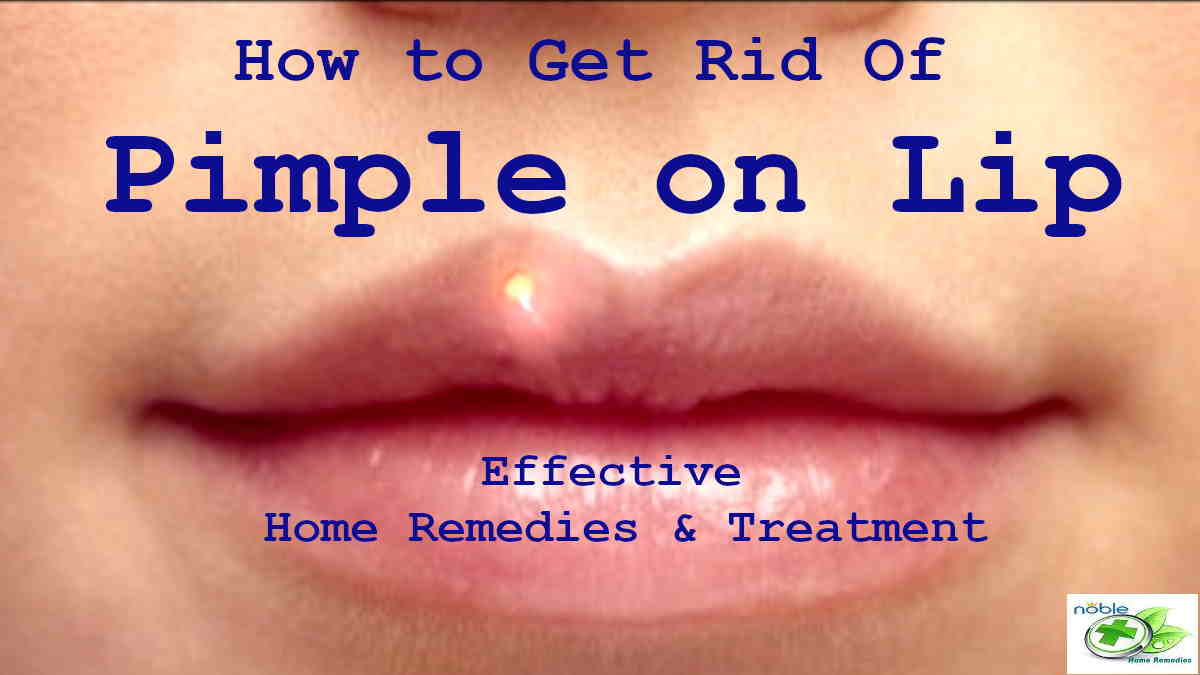 How to Get Rid of a Pimple on Lip? Best 9 Remedies