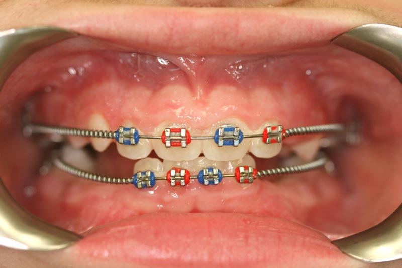 Braces Nonextraction Straightwire Technique NonExtraction