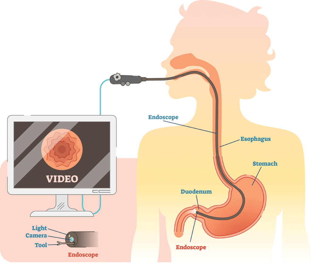 What's the Scope? Spotlight on Endoscopic Ultrasound Northeast Digestive