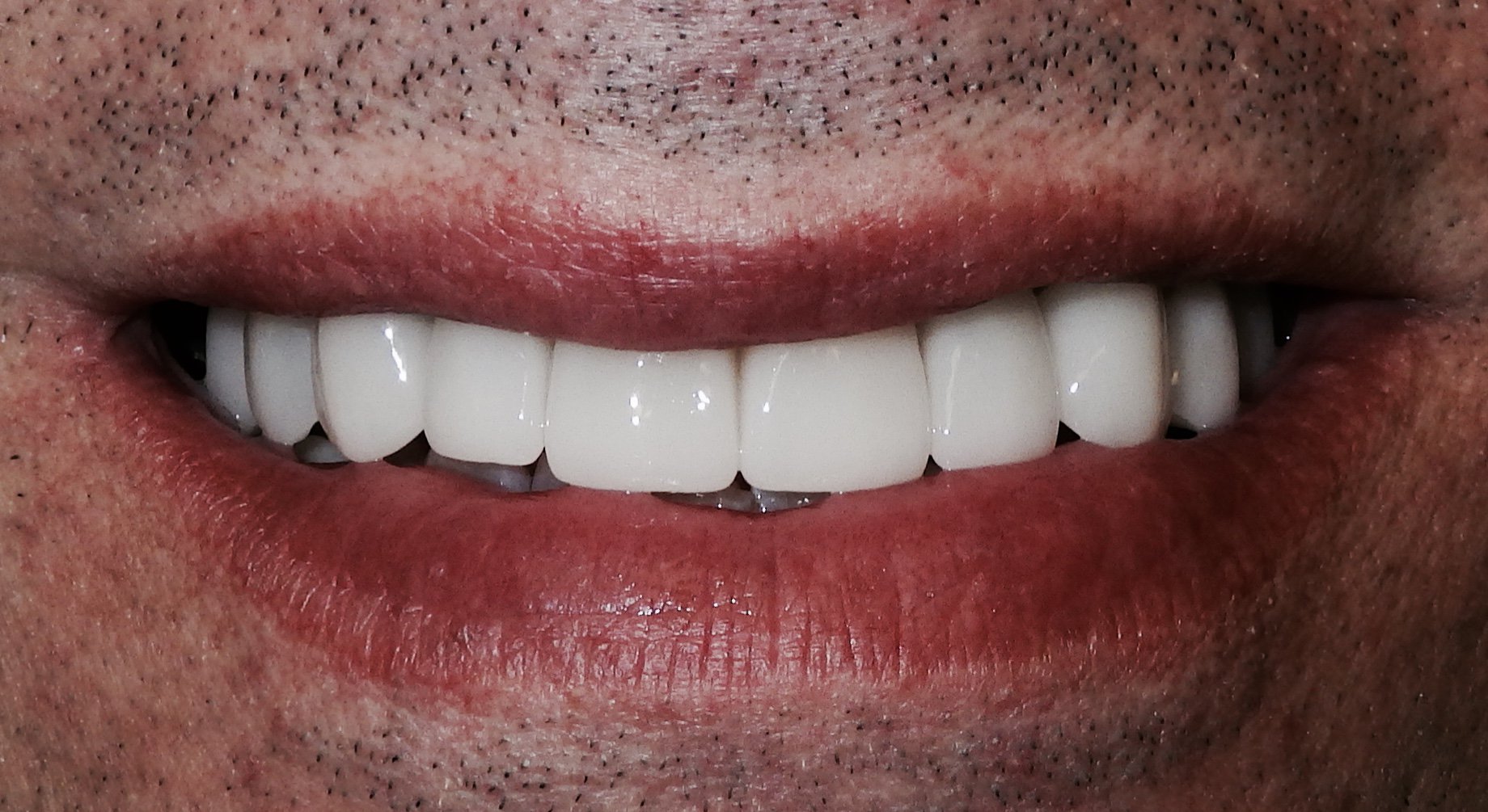 Dental Case Study 37 North Shore Restorative and Implant Dentistry