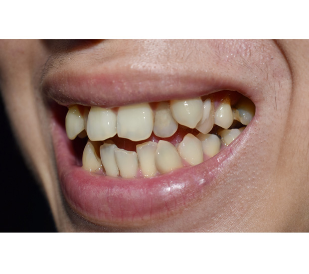 Impacted Tooth Northside Minnesota Oral & Maxillofacial Surgeons Coon