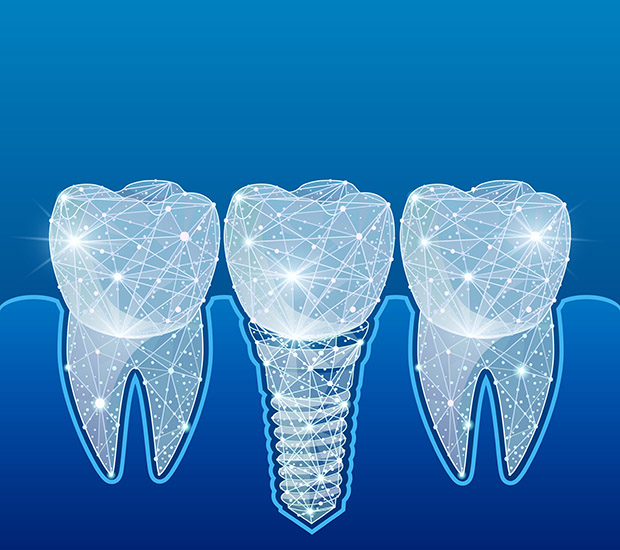 Dental Implants Northside Minnesota Oral & Maxillofacial Surgeons in