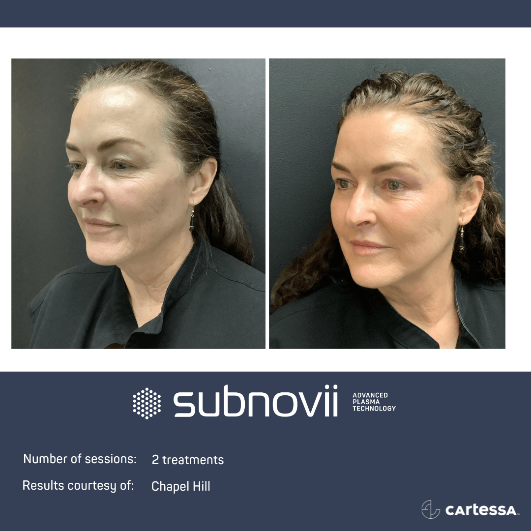 Subnovii Plasma Treatment in Southlake NonSurgical Facelift