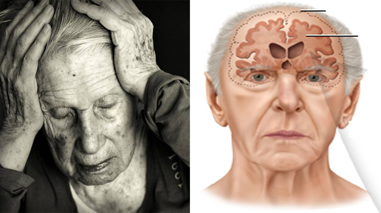 Con Solo 1 Ejercicio Al DÃa Puedes Prevenir El Alzheimer Y Mantener Tu
