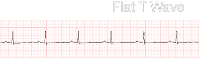 ECG Changes Associated with Myocardial Injury - ST Segment Changes - Acute  Coronary Syndrome - Cardiology Teaching Package - Practice Learning -  Division of Nursing - The University of Nottingham
