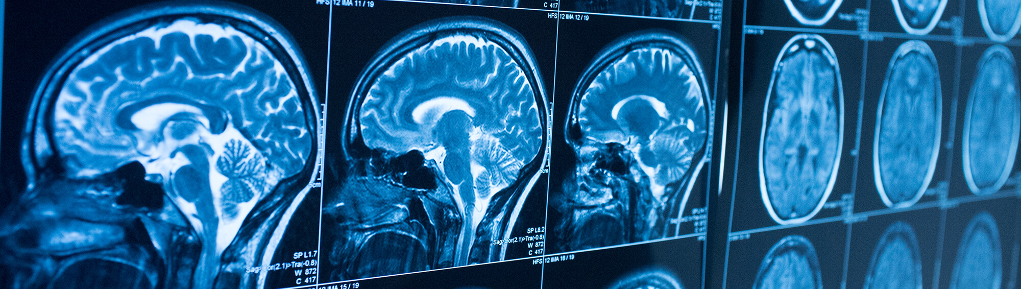 What to Know About Drinking Alcohol After a Traumatic Brain Injury