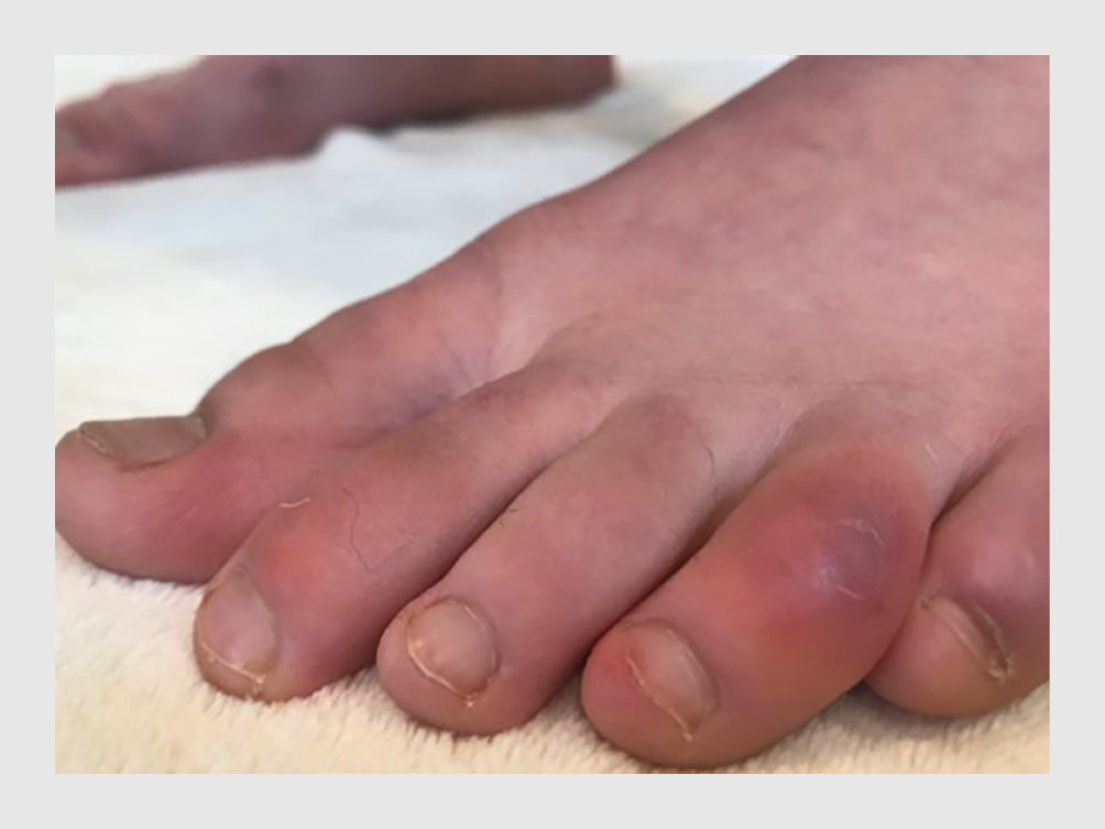 Huidafwijkingen Bij Covid-19 | Ntvg