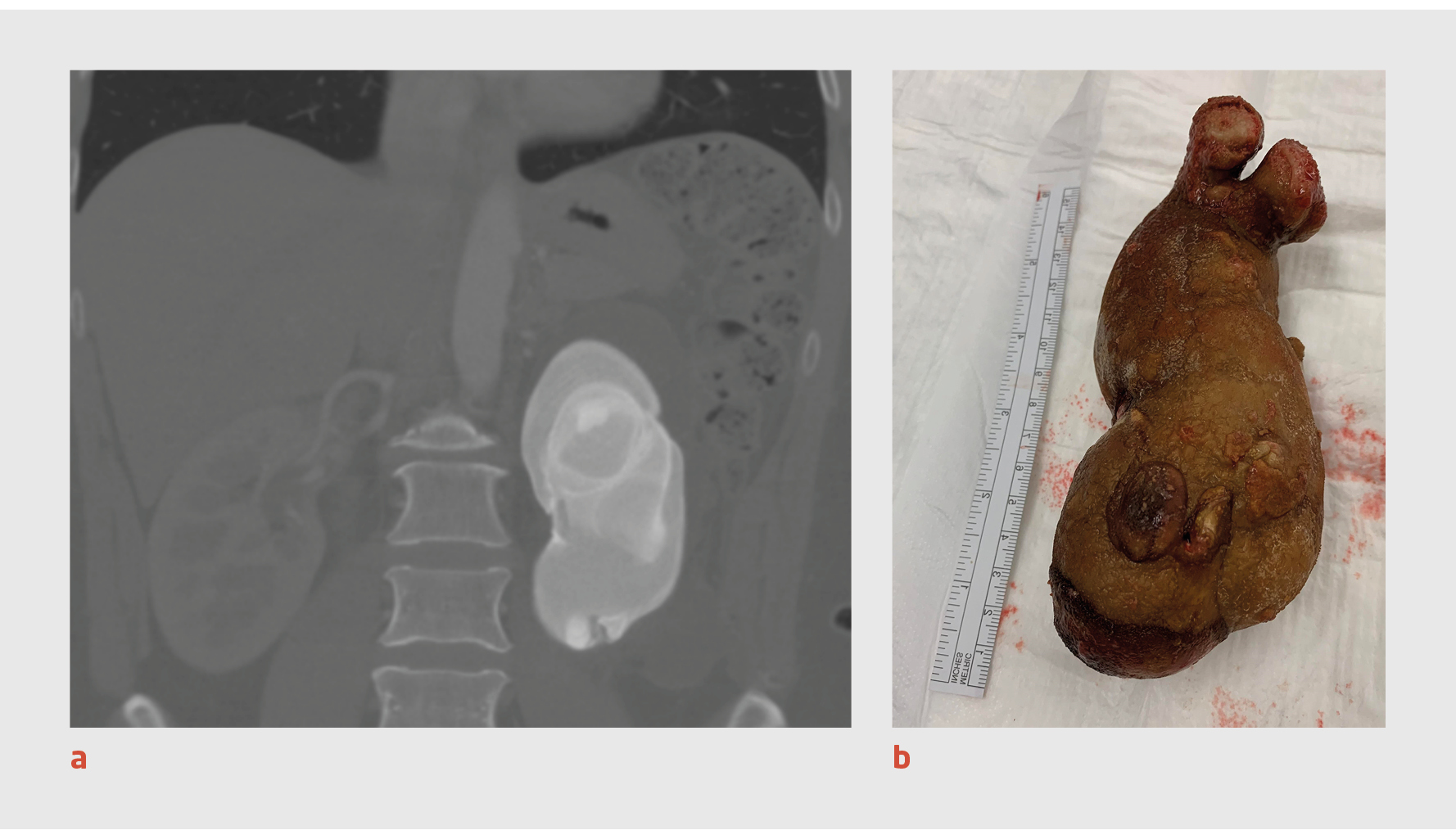 Een Vrouw Met Een Palpabele Zwelling, Hematurie En Flankpijn | Ntvg