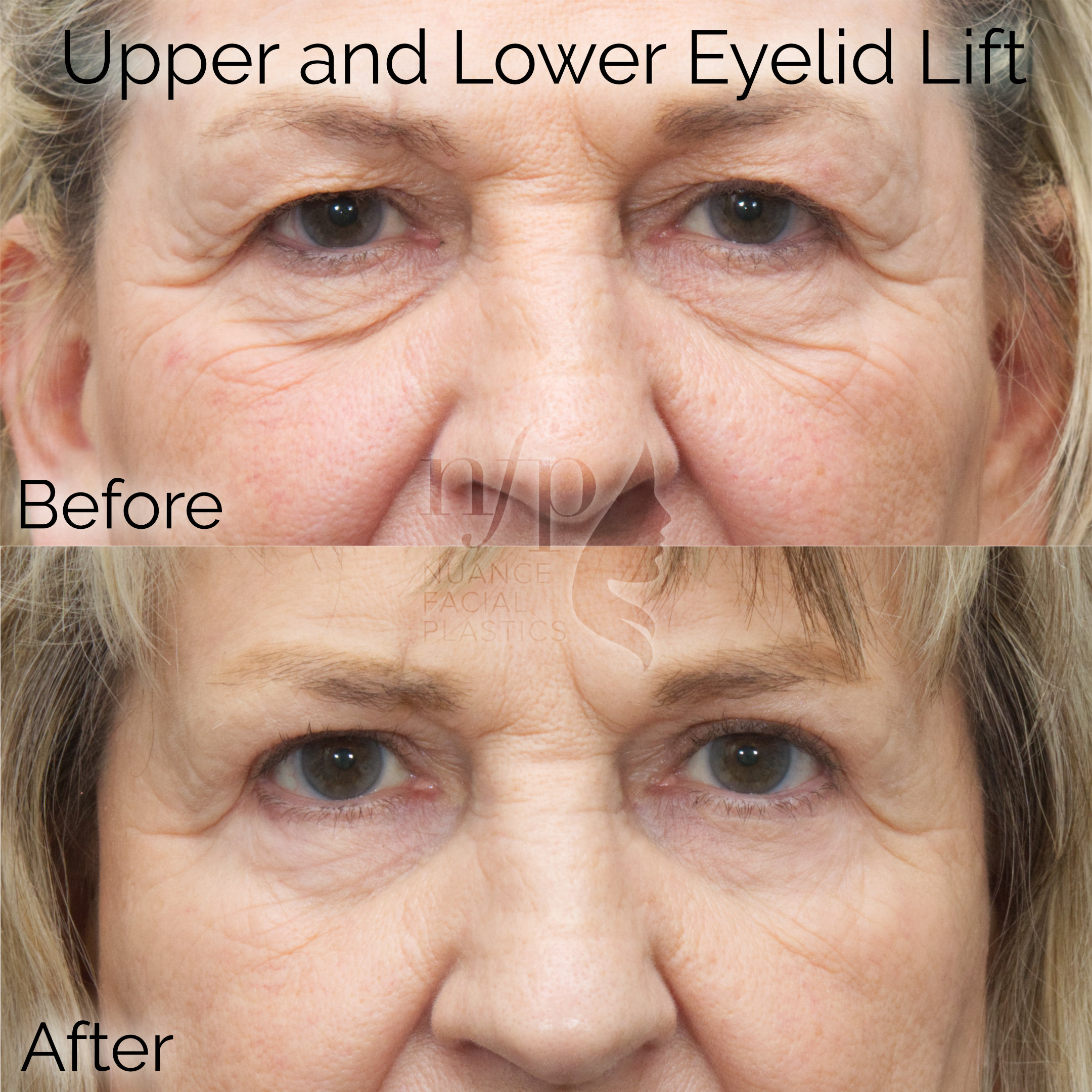 Lower Eyelid Lift (Blepharoplasty) Nuance Facial Plastics, Charlotte