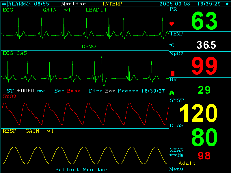 Reading a Patient Monitor. The Nurses Post