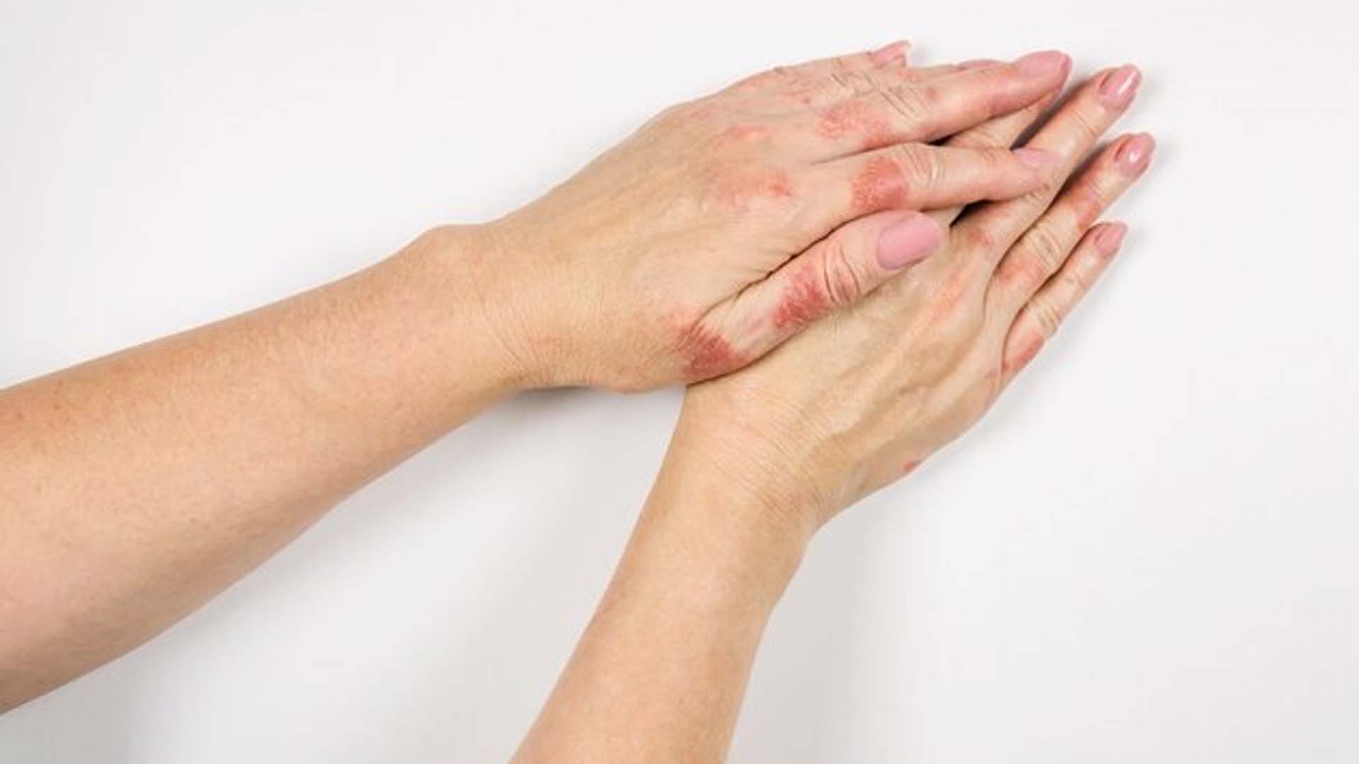 Can Dairy Products Cause Eczema? NutritionFact.in