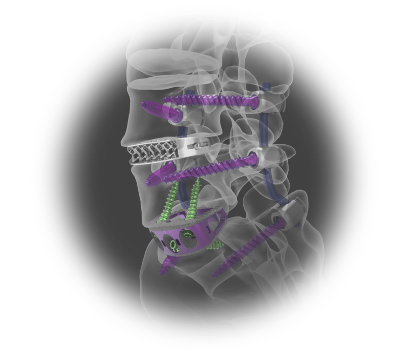 NUVASIVE XLIF SURGICAL TECHNIQUE PDF