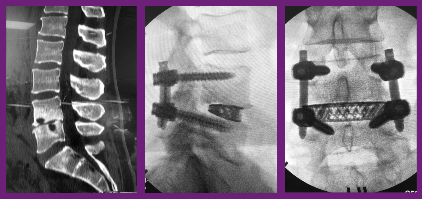 Featured Case X360 featuring Modulus XLIF, Reline and LessRay NuVasive