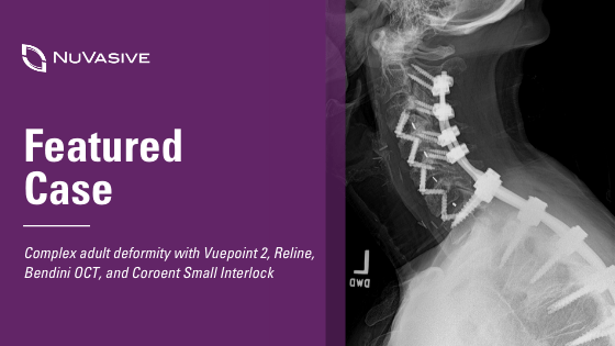 Featured Case Complex adult deformity with Vuepoint 2, Reline, Bendini