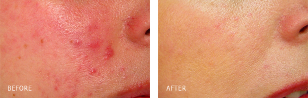 Facial Vein Treatment Los Angeles Laser Under Eye Vein Removal
