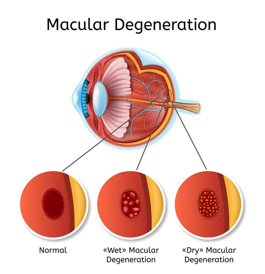 Treatment Breakthroughs for Macular Degeneration in 2022 NVISION Eye